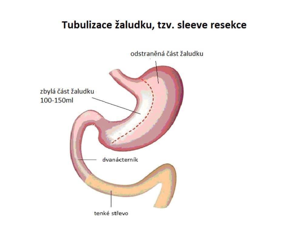 Tzv. sleeve resekce na nákresu.