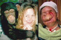Ženu znetvořil šimpanz, český lékař jí vrátil obličej