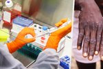 Vakcína proti pravým neštovicím jako prevence opičích neštovic? EU doporučuje!