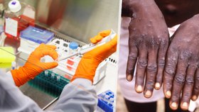 Vakcína proti pravým neštovicím jako prevence opičích neštovic? EU doporučuje!