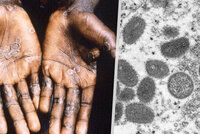 První oběť opičích neštovic mimo Afriku: Muže (†41) z Brazílie trápily i jiné nemoci