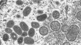 V Česku se objevily další tři případy opičích neštovic. ÚVN ruší na klinice návštěvy