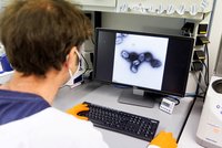 Česko má dalšího nakaženého opičími neštovicemi. První mimopražský případ hlásí Ústí