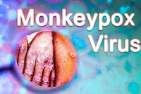 V Česku zemřel první člověk s opičími neštovicemi. Měl zánět plic a HIV, uvedlo ministerstvo