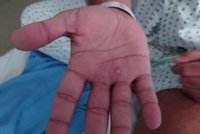 První případ opičích neštovic u dítěte! Podle pražských hygieniků je na vině zahraniční dovolená