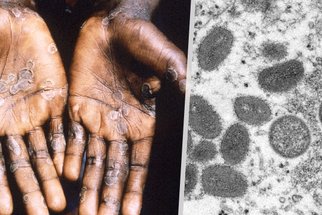 Opičí neštovice: Co jsou zač a jak jsou nebezpečné