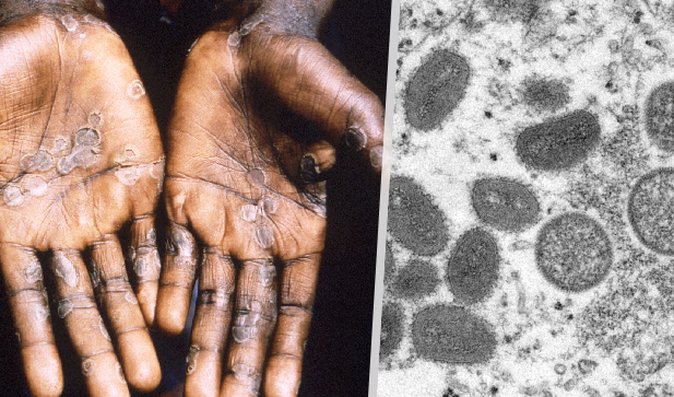 Opičí neštovice: Co jsou zač a jak jsou nebezpečné