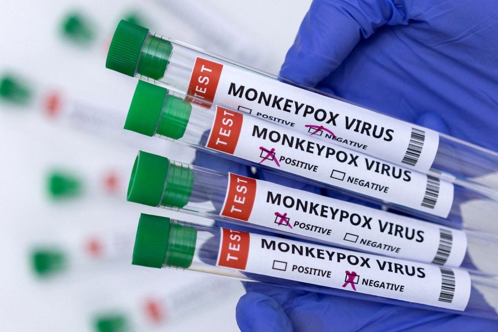 V Čechách už je 6 potvrzených případů opičích neštovic. (ilustrační foto)