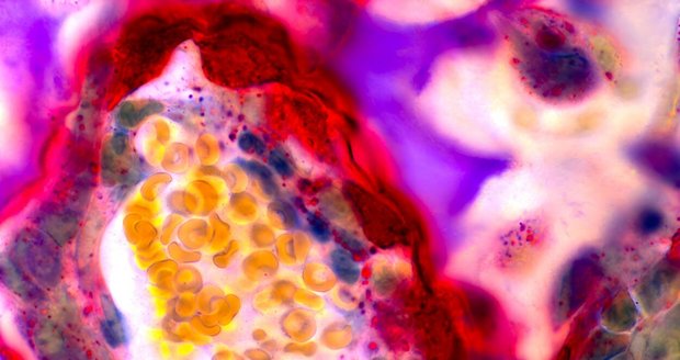 Osteoporóza se nejčastěji týká starších lidí, výrazněji žen po menopauze. Riziko ale s věkem roste také u mužů.