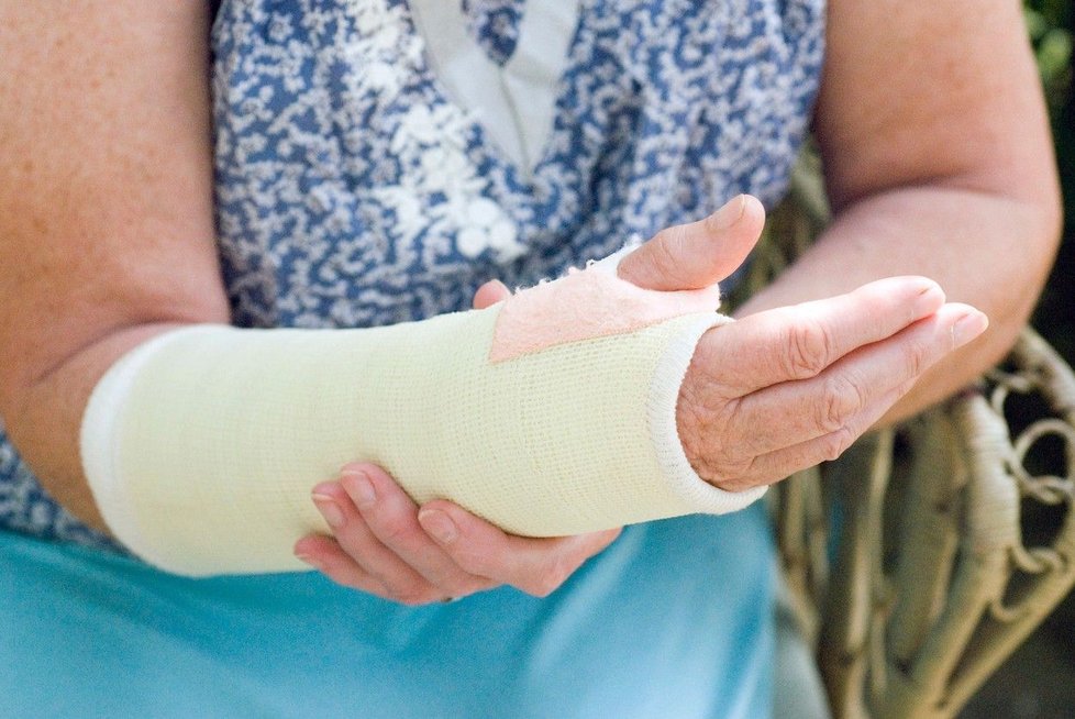 Osteoporóza může znamenat nejen zlomeniny, ale i smrt.