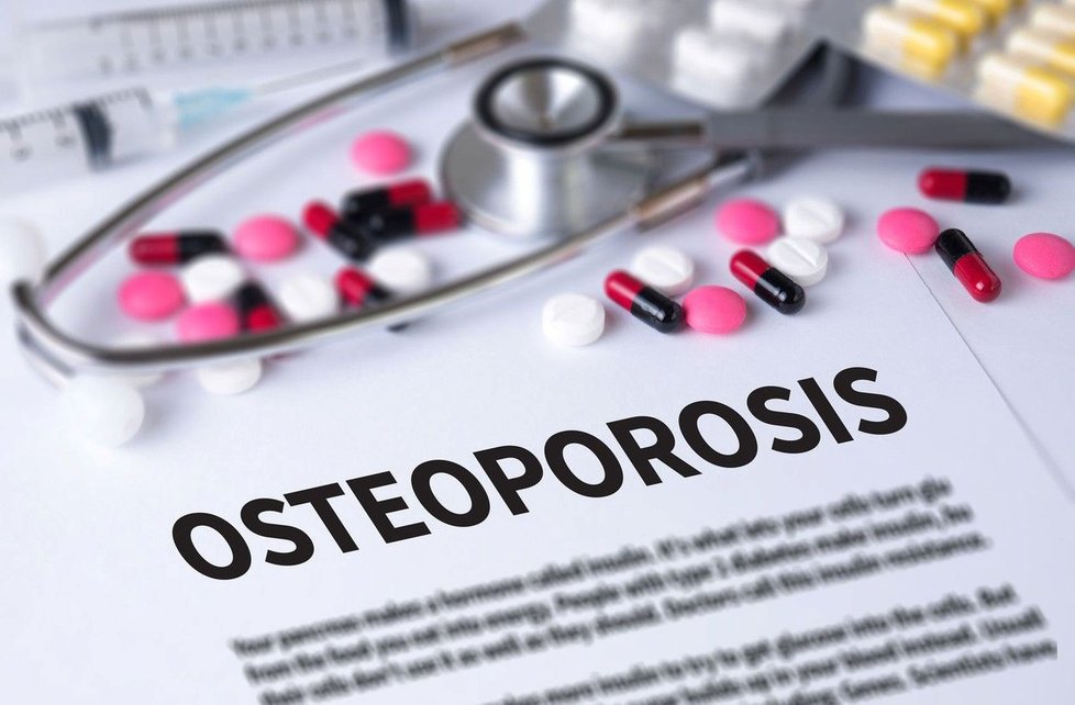 Osteoporóza může znamenat nejen zlomeniny, ale i smrt.