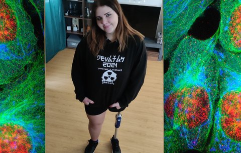 Dáša (17) přišla kvůli nádoru o nohu: Aby si mohla splnit sny, potřebuje bionickou protézu