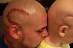 Otec si nechal vytetovat na hlavu jizvu, kterou má jeho syn po odstranění nádoru z mozku.