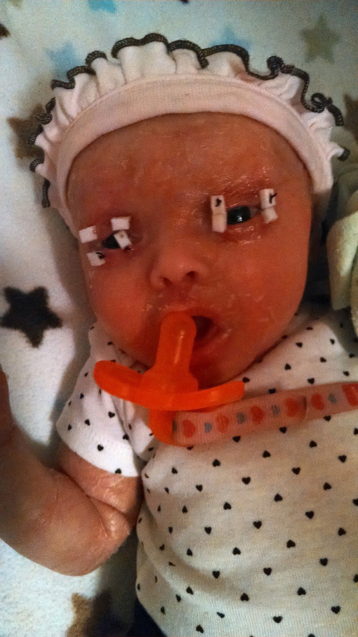 Po narození jí museli operovat oční víčka.