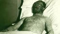 Neštovice během epidemie u pacienta v Milwaukee ve Wisconsinu v roce 1925, který později zemřel. Dobový popisek říká, že jde o neočkovaného křesťanského vědce, který si myslel, že by silou mysli mohl zabránit neštovicím.