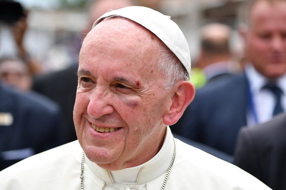 Papež František ztratil rovnováhu při cestě automobilem v kolumbijské Cartageně. Má podlitinu na tváři a roztržené obočí, jeho stav ale není vážný.