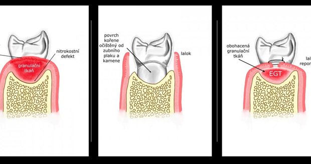 Nový postup brněnského léčení je založený na tom, že lékaři z úst pacientovi setřou a obohatí  granulační tkáň, která je součástí jeho úst. 