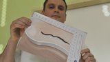 Nový parazit v Česku: V močovém měchýři  ženy byl 10centimetrový červ