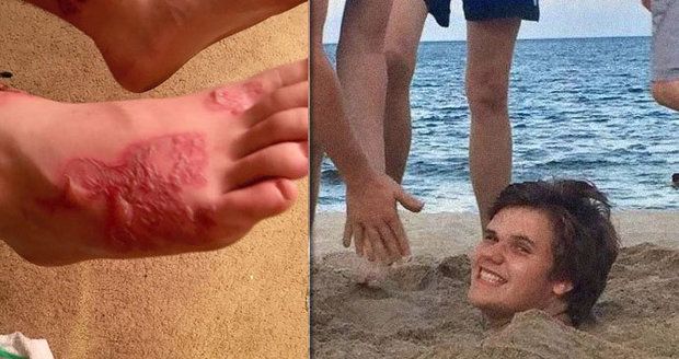 Michaela (17) na pláži zakopali do písku: Do nohy se mu nastěhovali červi