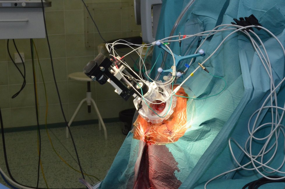 Moderní chirurgická aplikace s elektrodami na pacientově hlavě
