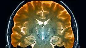 Mozek pacienta s Parkinsonovou chorobou
