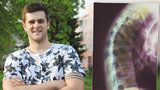 23letému Milanovi tuhne páteř. Píchá si injekce do stehen kvůli Bechtěrevovi