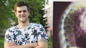 Milan trpí Bechtěrevovou chorobou, pomáhá mu biologická léčba