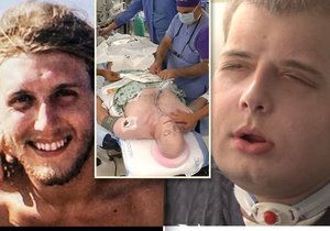 Popálený hasič prodělal rozsáhlou transplantaci obličeje: Tvář dostal od 26letého cyklisty!
