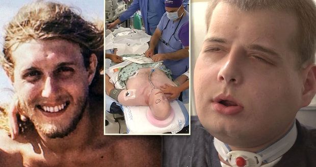 Popálený hasič prodělal rozsáhlou transplantaci obličeje: Tvář dostal od 26letého cyklisty!