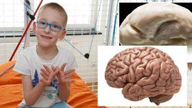 Patrik (7) trpí vzácnou vývojovou vadou: Má hladký mozek bez závitů