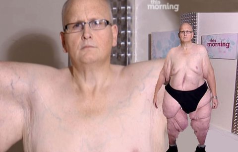 Kdysi nejtlustší muž světa pózuje nahý, nemá na operaci