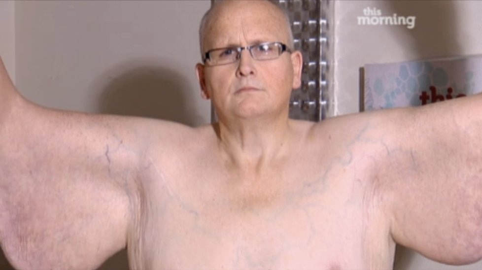 Paulu Masonovi odstranili lékaři 27 kilo visící kůže.