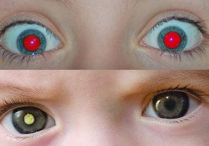 Jedna fotka odhalí, zda jsou vaše oči v pořádku, nebo zda máte urychleně vyhledat lékaře. Zdravé oči jsou na horní fotografii