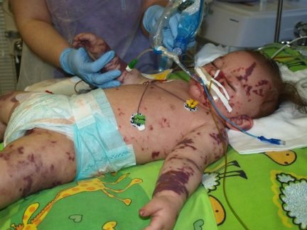 V sedmi měsících bojovala holčička v nemocnici o život.
