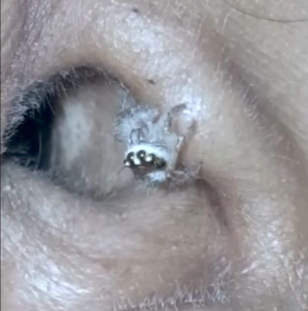 Žena v Indii měla v uchu živého pavouka