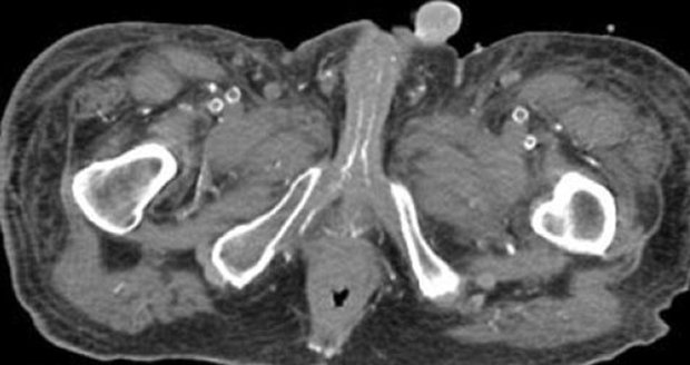 Muži kvůli nemoci krve odumřel penis.