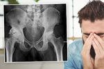 Muž zjistil v nemocnici, že se jeho penis mění v kost a utekl.