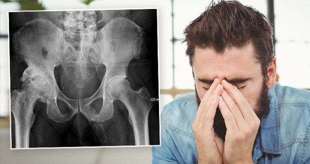 Můj penis se mění v kost! Muž zjistil šílenou diagnózu při rentgenu
