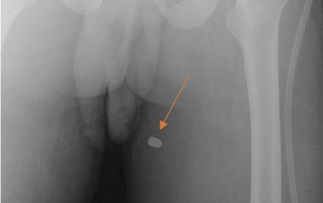 Šokující rentgenový snímek ukazující rozštěpený penis i kulku ve stehně.