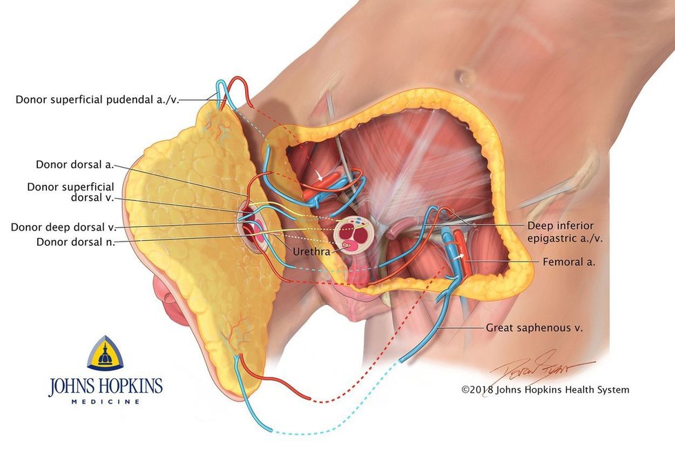 Takhle proběhla první transplantace penisu na světě