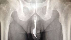 To muselo bolet: Důchodce (70) z Austrálie si narval do penisu vidličku!