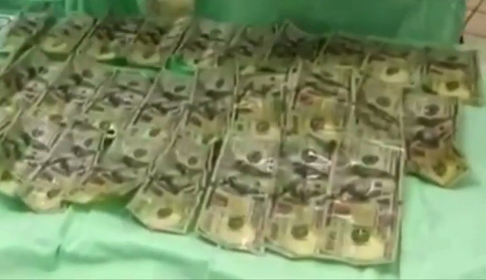 Peníze, které lékaři vytáhli ženě ze žaludku.