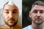 Brutální útok kvůli boxerskému zápasu: Muž (25) přišel o kus lebky!