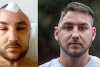 Brutální útok kvůli boxerskému zápasu: Muž (25) přišel o kus lebky!