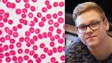 Petr (16) trpí hemofilií: Stres z pandemie nemoc zhoršuje, pacienti mohou snáz krvácet