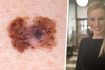 Petra onemoněla melanomem v těhotenství