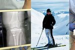 Hejtmanka Petra Pecková utrpěla úraz při lyžování v rakouských Apách (březen 2023)