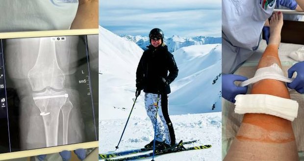 Hejtmanka Pecková je po operaci: Ošklivý úraz při lyžování v rakouských Alpách! 