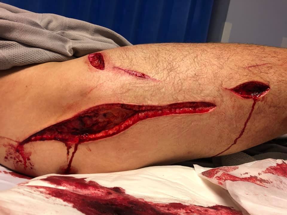Další případ útoku žraloka v Austrálii. Phil Mummert naštěstí přežil.