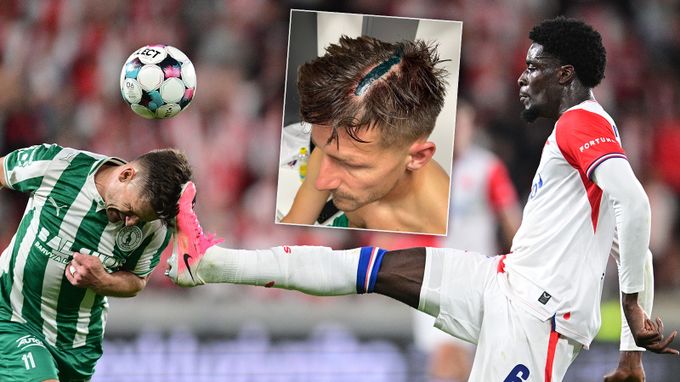 Bohemians ukázali, jak na Slavii skončil Pilař. 10 stehů a názory, jaká karta měla padnout Bohemians ukázali, jak na Slavii skončil Pilař. 10 stehů a názory, jaká karta měla padnout